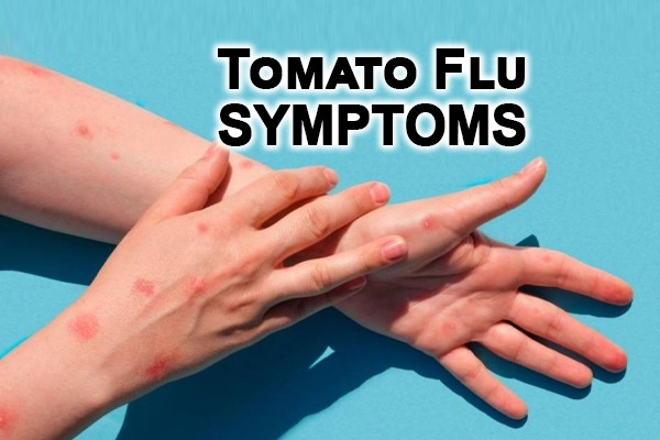 tomato flu symptoms in hindi, tomato flu के लक्षण 